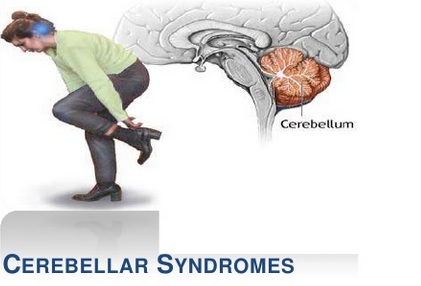 Cerebellar syndrome - Hình ảnh minh họa